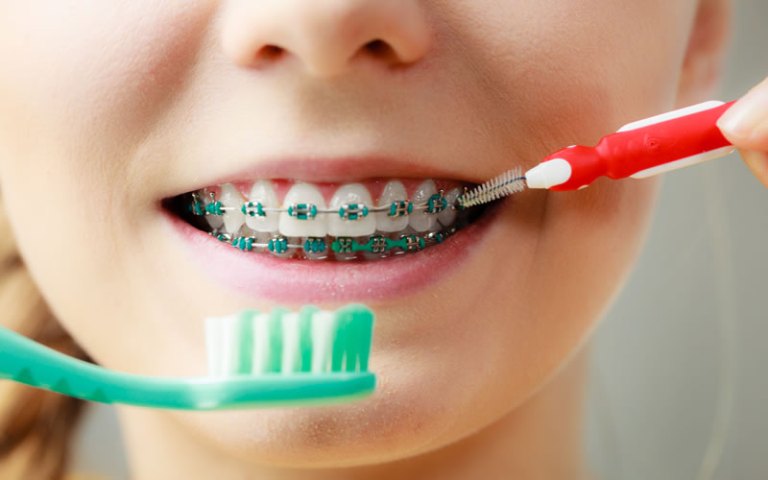Dişlər gündə 4-5 dəfə fırçalanmalıdır