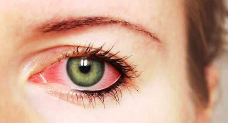 Göz təzyiqinin simptomları